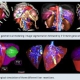 Preoperative Patient- Specific Liver Surgical Simulation