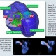 Large Scale Simulations in Pediatric Cardiology: Towards the Personalized Virtual Child Heart